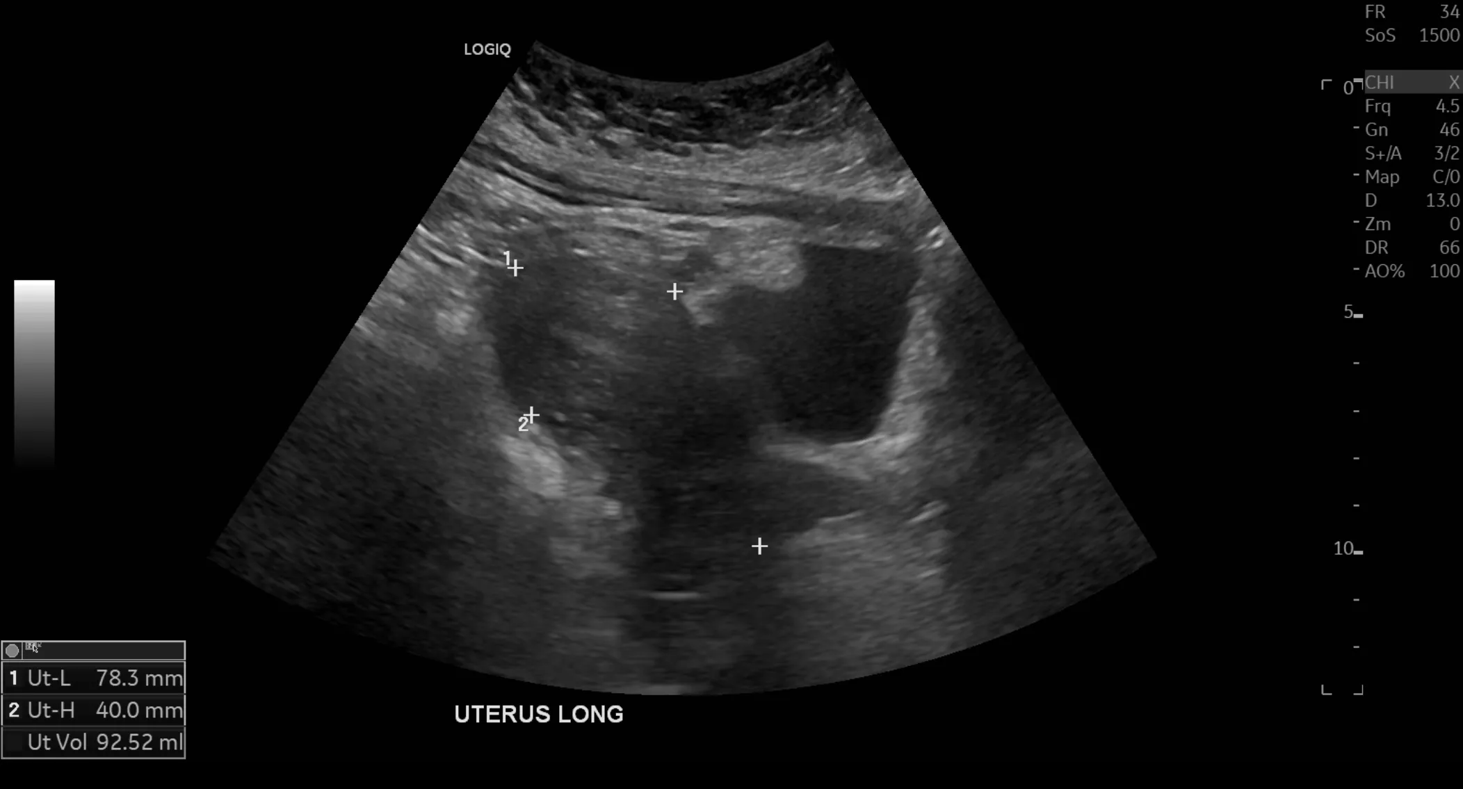 Pelvic ultrasound